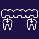 Dental Bridge