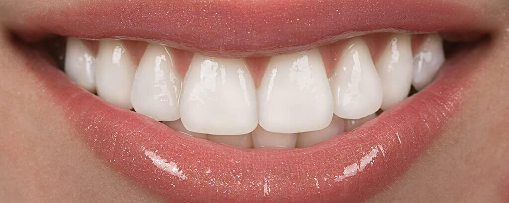 Veneers 11 1024x410 1